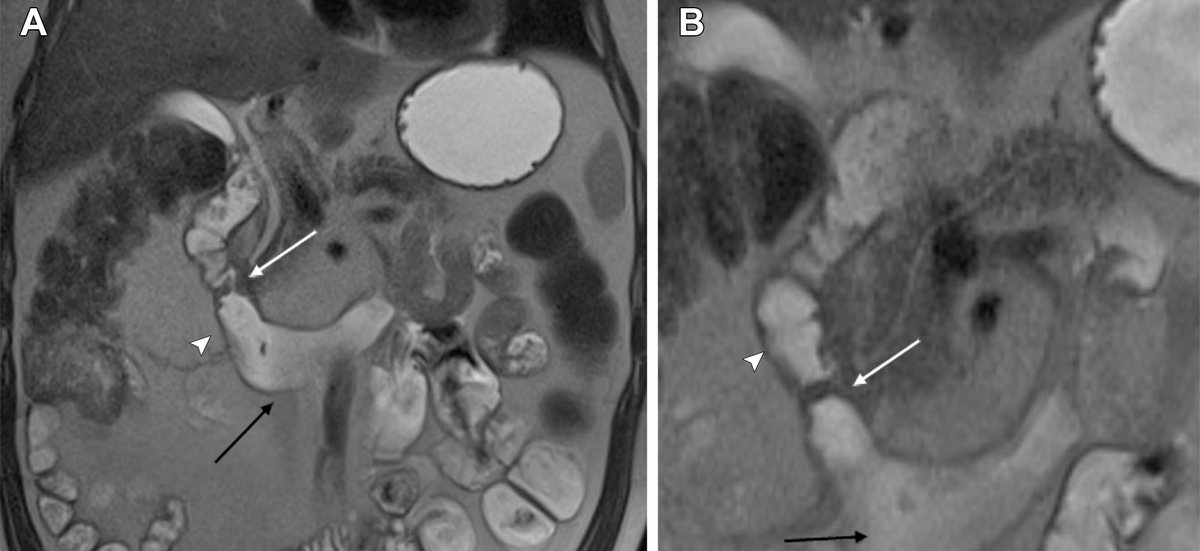 The authors review the spectrum of intestinal and extraintestinal findings of celiac disease at CT and MR enterography and review associated complications. bit.ly/3PPkU4B @diagnosticoHI @andrepenizzotto