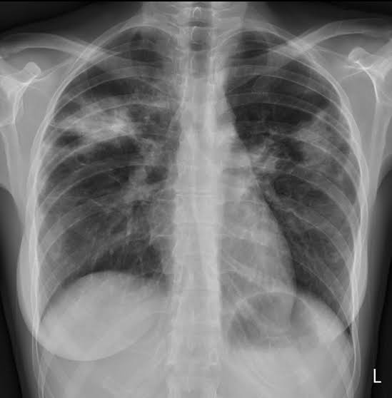 Spot diagnosis
Chest x-ray of a patient with fever, cough with wheezing,dyspnea and ascaris infestation.
Dx?
What are the other parameters for the diagnosis?
Other causes of the disease?
Any treatment?
#MedTwitter #MedX #medicine #pathology #parasite 
@Sthanu5 @IhabFathiSulima…