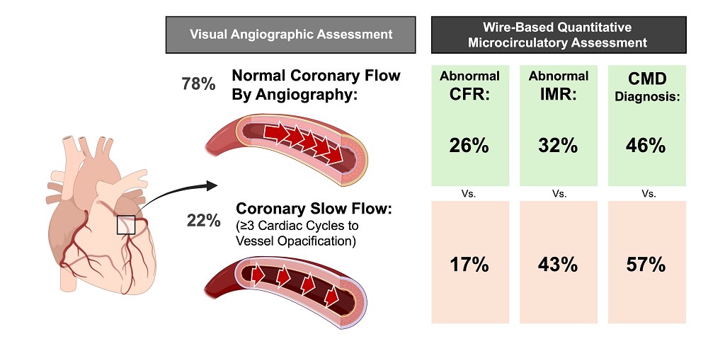 Is coronary slow-flow a surrogate marker for physiologically proven coronary microvascular dysfunction? #INOCA #ANOCA #cardiotwitter #MedEd #AHAJournals @NSmilowitzMD @AHausvater ahajournals.org/doi/abs/10.116…