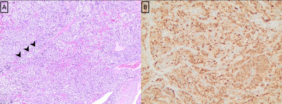 Charlotte S. Taylor (@cstaylor) on Twitter photo Love a challenging thyroid case?
🌟Check out our latest article with our wonderful <a href="/UMMC_Pathology/">UMMC Pathology</a> colleague <a href="/VarshaManuchaMD/">Varsha Manucha, MD</a>, <a href="/ENTatUMMC/">ENTatUMMC</a> colleagues Dr. Jackson & Dr. Kane, R2 <a href="/UMMCRads/">UMMC Department of Radiology</a> <a href="/kirbyparker17/">Kirby Parker</a>, and rising star medical students. It was fun working with all of you! Love a challenging thyroid case?
🌟Check out our latest article with our wonderful <a href="/UMMC_Pathology/">UMMC Pathology</a> colleague <a href="/VarshaManuchaMD/">Varsha Manucha, MD</a>, <a href="/ENTatUMMC/">ENTatUMMC</a> colleagues Dr. Jackson & Dr. Kane, R2 <a href="/UMMCRads/">UMMC Department of Radiology</a> <a href="/kirbyparker17/">Kirby Parker</a>, and rising star medical students. It was fun working with all of you!