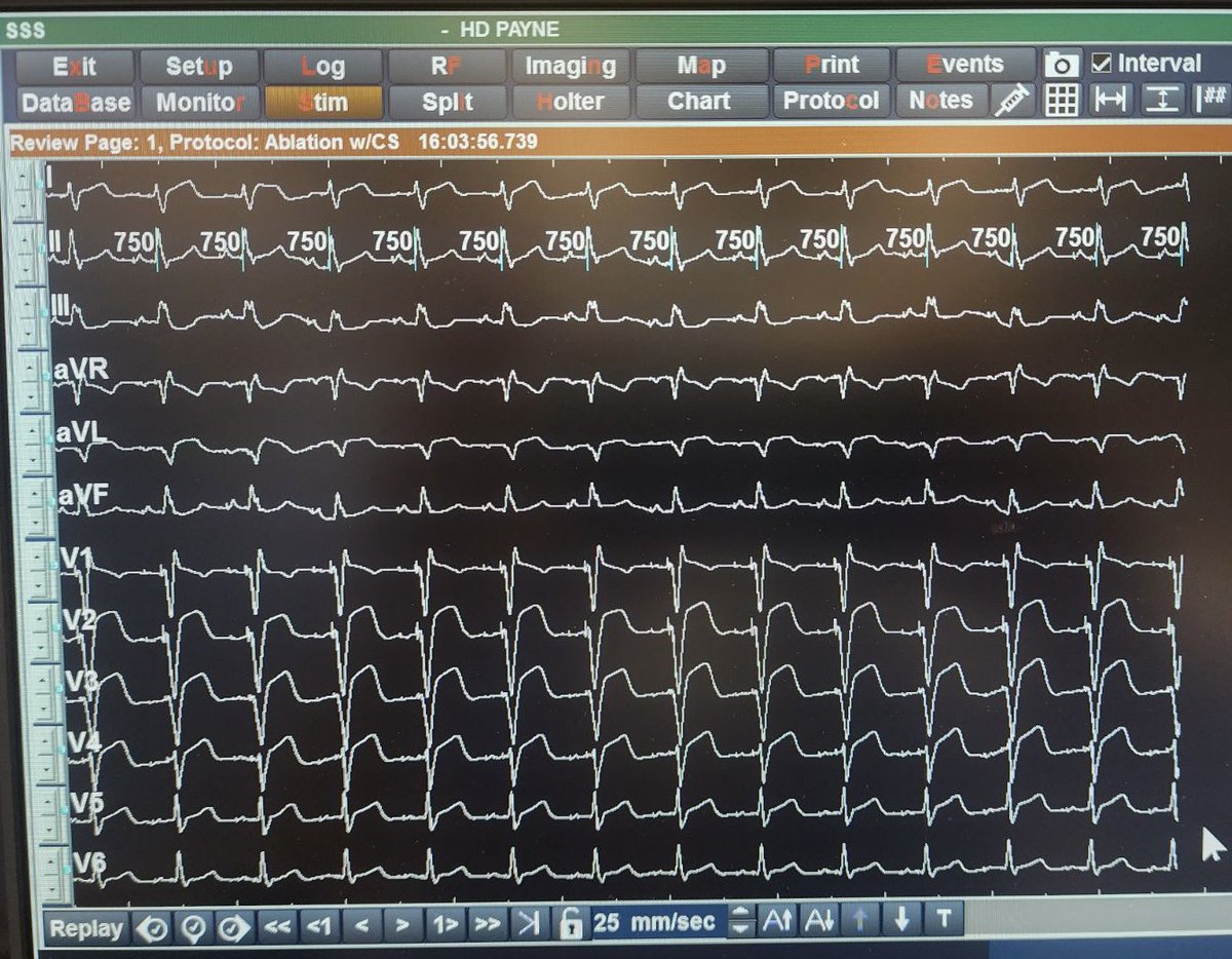 Dabbling in the atrial CSP space. 

How does my p-wave look <a href="/MaggieInfeld/">Maggie Infeld</a> ??