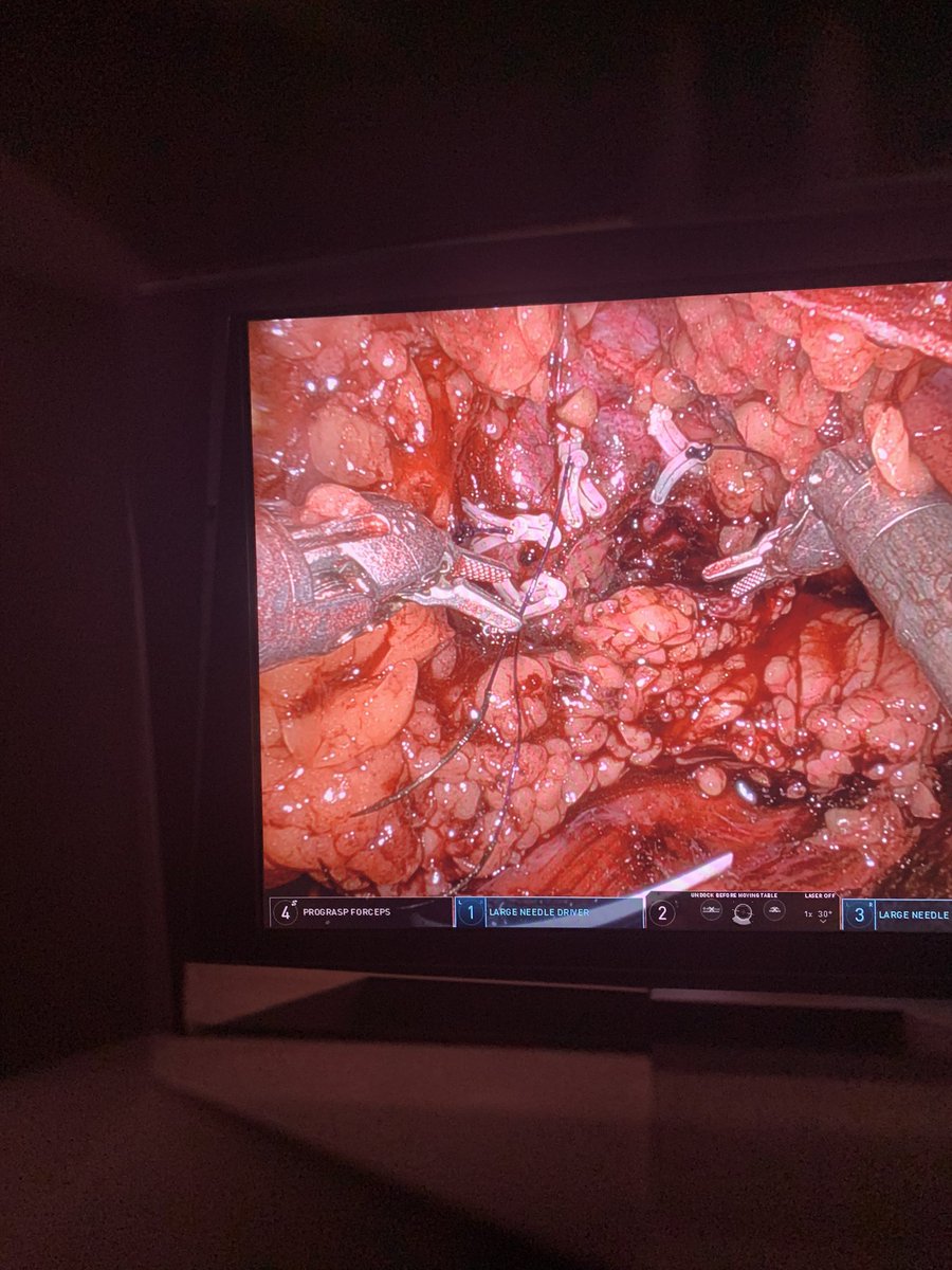 Greg Kyriazis (@greg_kyriazis) on Twitter photo My 200th robotic kidney case as a consultant in Mid Yorkshire Teaching NHS Trust. And what a case! Robotic retroperitoneal partial nephrectomy for a 3.2cm hilar tumour <a href="/innersightlabs/">innersightlabs</a> <a href="/IntuitiveSurg/">Intuitive</a> <a href="/MidYorkshireNHS/">Mid Yorkshire Teaching NHS Trust</a> @DosMyht My 200th robotic kidney case as a consultant in Mid Yorkshire Teaching NHS Trust. And what a case! Robotic retroperitoneal partial nephrectomy for a 3.2cm hilar tumour <a href="/innersightlabs/">innersightlabs</a> <a href="/IntuitiveSurg/">Intuitive</a> <a href="/MidYorkshireNHS/">Mid Yorkshire Teaching NHS Trust</a> @DosMyht