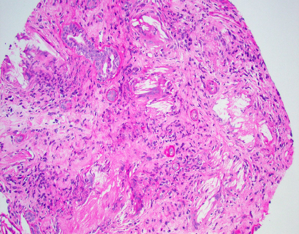 Nice example of chronic uric acid nephropathy (gouty tophus) in a pt with CKD. #renalpath #PathTwitter