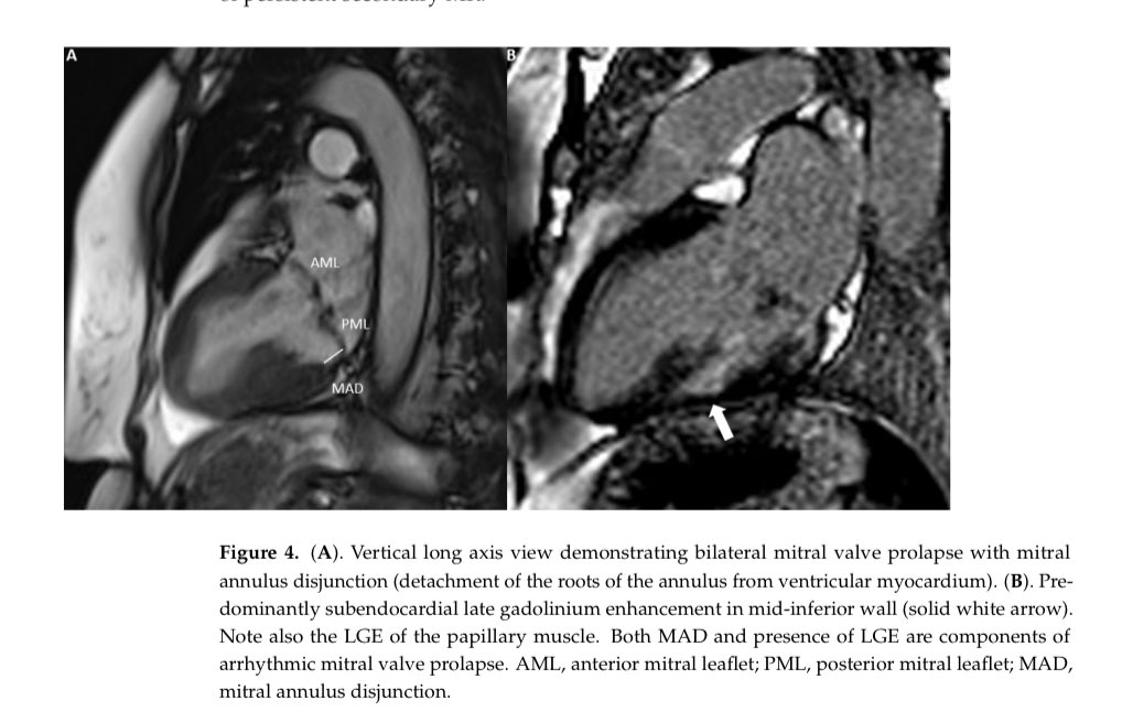 The Role of Cardiovascular Magnetic Resonance Imaging in the Assessment of Mitral Regurgitation. doi.org/10.3390/diagno… #CardioEd #CardioTwitter #mitralvalve #MedEd