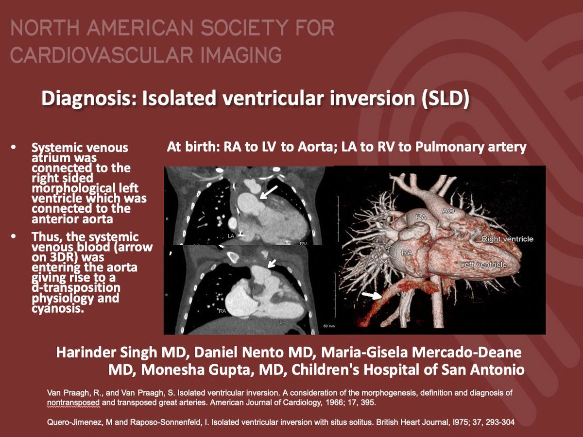 #NASCI Case Series Case 73 Diagnosis #whyCMR #YesCCT @GregKicska @JRevRad1 @dianalitmano @DanielVargasMD @kirschj @prachipagarwal @AwsHamid5 @CarlottaOnnis @DeCeccoCN