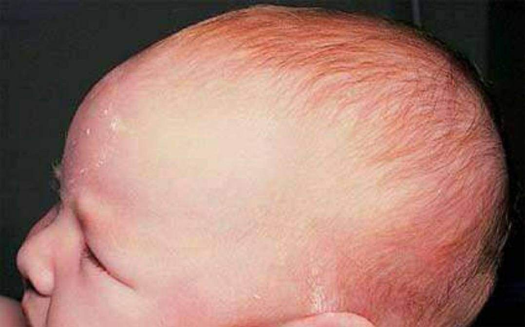 Bulging fontanelles are common while an infant is crying, vomiting, or lying down; if they are truly bulging while the infant is calm and upright, this indicates increased cranial pressure; possible causes include: encephalitis, hydrocephalus, or meningitis.