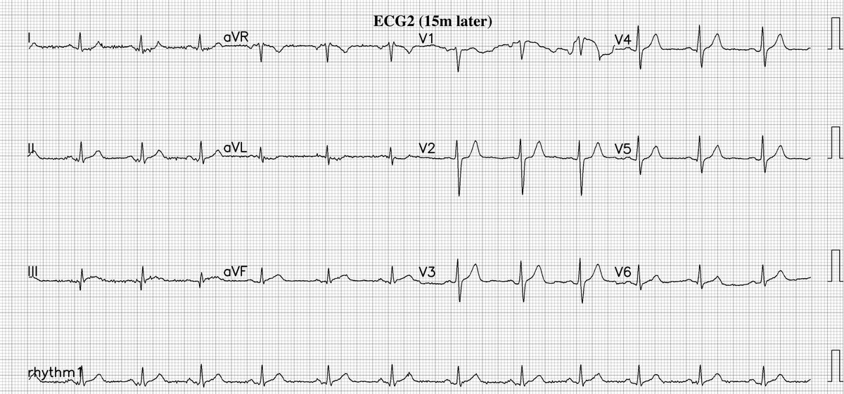 Typical CP w/o dynamic changes HsTn 0.01 ng/L Dx? @akneton @yolyabreuh @UlhasDr @DidlakeDW @ecgrhythms @IhabFathiSulima @DrPharmDMDTh @Vadeboncoeur_Al @smithECGBlog @EM_RESUS @iamritu @ecgandrhythmRoe @martinfd78 @estudiomedicina @OrlandoRPN @fxgodzeuss #Cardioed #FOAMcc