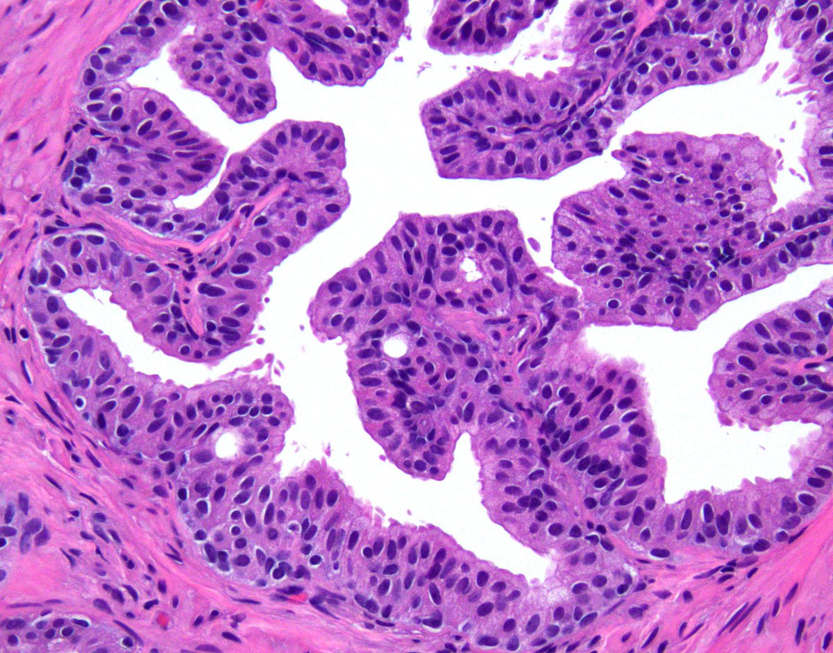 Classic morphology of #prostate Central Zone on needle biopsy:🚨can mimic high grade PIN - stratified epithelium w/eosinophilic cytoplasm - architectural complexity (micropapillary/tufted) - intraluminal bridges ('Roman arches') - evident basal cell layer (see R pic) #gupath