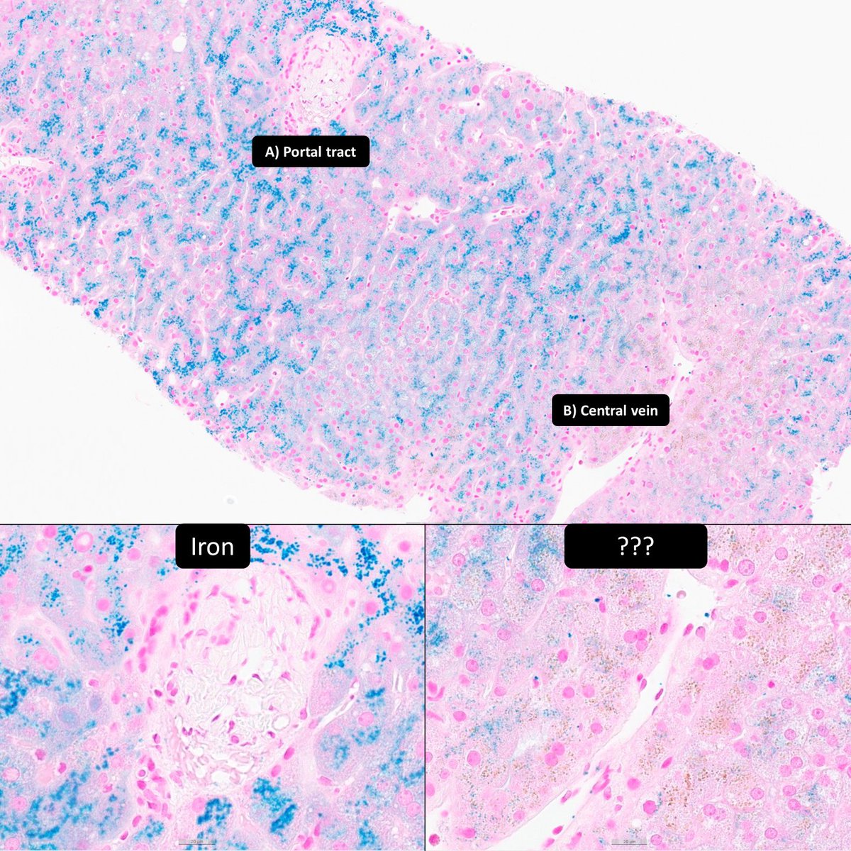 Case of Hemochromatosis shows granular iron pigment in periportal hepatocytes (A) What is the other pigment ⁉️ #GIPath #PathTwitter #LiverPath #PathResidents