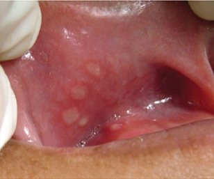 👩‍⚕️ Clinical Puzzle: A 28-year-old female complains of recurrent oral and genital ulcers, skin lesions, and uveitis. What rare inflammatory disorder do you suspect based on these symptoms? #MedTwitter #ClinicalCase #MedX
@IhabFathiSulima