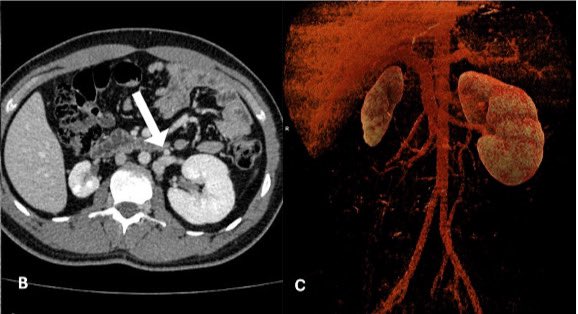 kolja_pantic's tweet image. Deep venous #thrombosis in patients with atresia of the inferior vena cava and right kidney hypoplasia (KILT syndrome): Systematic #review of the literature journals.sagepub.com/doi/10.1177/13… @drmmitrovic @VMJ_SVM