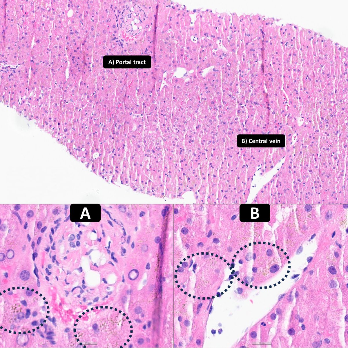 Pigment A or B = Iron?
#Hemochromatosis #LiverPath
🙏@johnhart20 at #uscap2024
#GIPath #PathTwitter #pathresidents