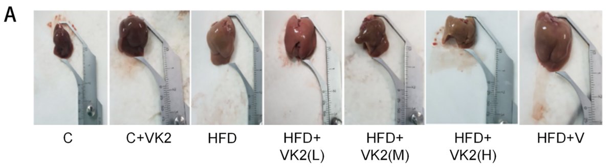 Low dose vitamin K2 reverses fatty liver disease.

Less than 1 mg (human equivalent dose) MK-7 daily completely protects and regenerates the liver.

High liver enzymes (ALT, AST, GGT, ALP) are the red flag - would consider supplementation.