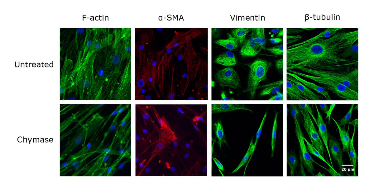 Mast cell chymase suppresses functional parameters in primary human airway smooth muscle cells. Xinran O. Zhao, Fabio Rabelo Melo, Christian P. Sommerhoff, Aida Paivandy, Gunnar Pejler Read the article here:doi.org/10.1111/all.16… Airway remodeling is a key feature in asthma.…