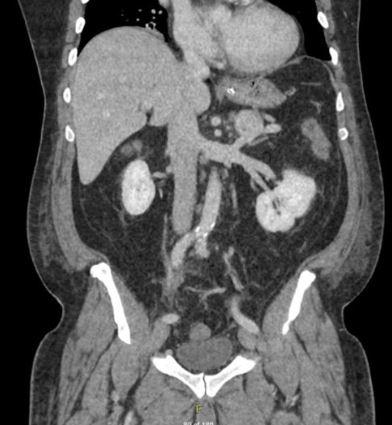 🔥WWYD Friday🔥 A 45 yo man has perforated diverticulitis and a large abscess. Operation is thought to be indicated due to sepsis and persistent SBO. There is also an incidental 8 cm L adrenal mass (partially seen in the photo -- but it is 8 cm) WWYD? (poll on next page) (1/)