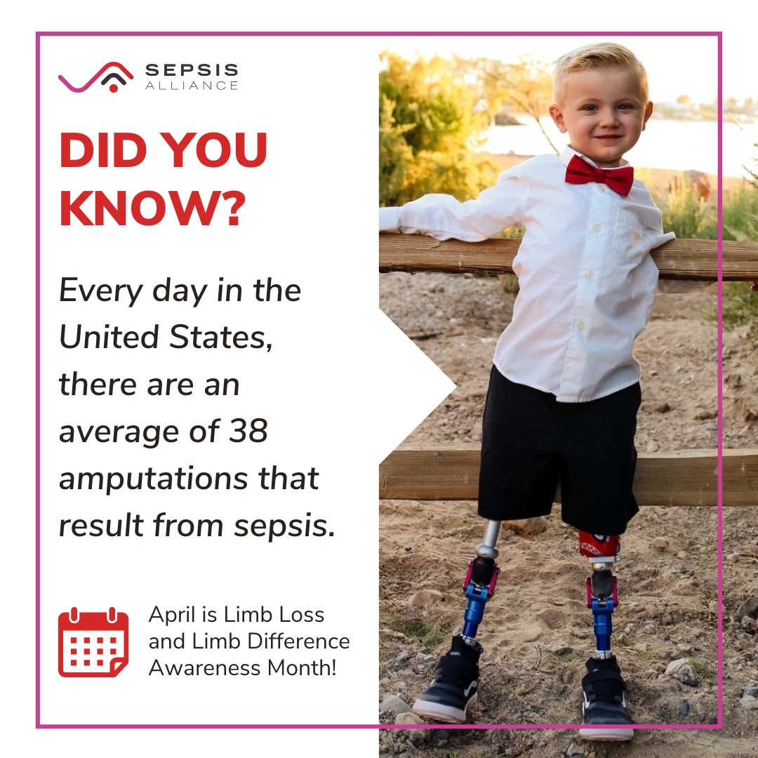 Did you or a loved one need to have an amputation as a result of #sepsis? In honor of Limb Loss and Limb Difference Awareness Month, and sepsis survivors like Beauden, we encourage you to share your experience in the comments below. #LLLDAM