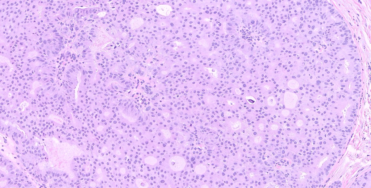 1/Another classical #breastpath case. 
VAE specimen with the following histology 👇👇👇
Some IHCs (though not really needed..) in the thread.
#pathology #PathTwitter