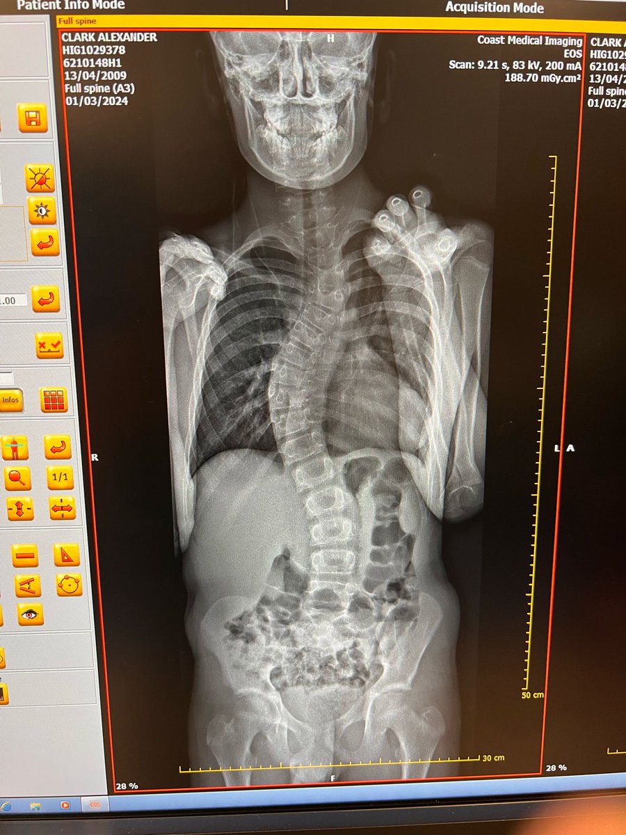 timrudge17's tweet photo. Central coast, bowls spin &amp; loves watching you and Oz. It’s his birthday on April 13th &amp; I wondered if you could send him a short video to say “stick with it champ, you’ll come back stronger etc.” His name is Alex Clark and his back looks like this - if you can help, he’d love it https://t.co/DqdDhsl0eL