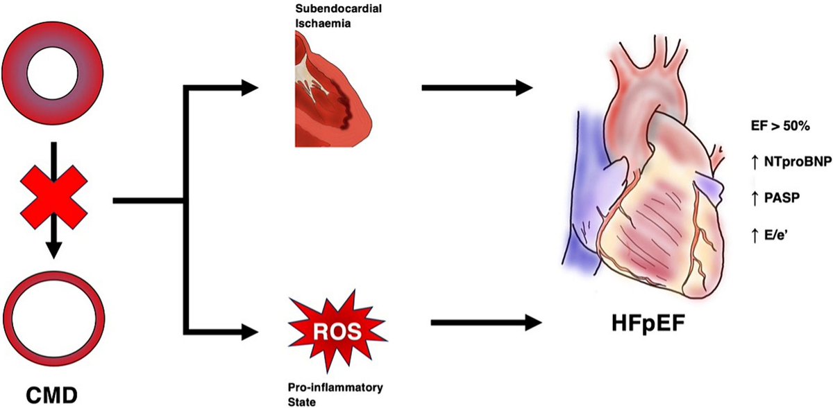 HFpEF is a growing healthcare burden, and CMD is prevalent among sufferers. We discuss this association + the gaps in evidence in our review in AHJ+:

🫀CMD as part of the pro-inflammatory paradigm in HFpEF.

➡️CMD as a pathophysiological driver.

bit.ly/CMD-HFpEF