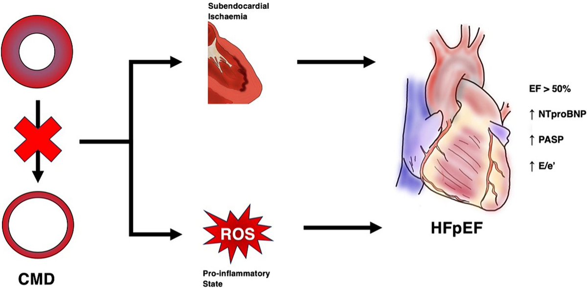 HFpEF is a growing healthcare burden, and CMD is prevalent among sufferers. We discuss this association + the gaps in evidence in our review in AHJ+: 🫀CMD as part of the pro-inflammatory paradigm in HFpEF. ➡️CMD as a pathophysiological driver. bit.ly/CMD-HFpEF