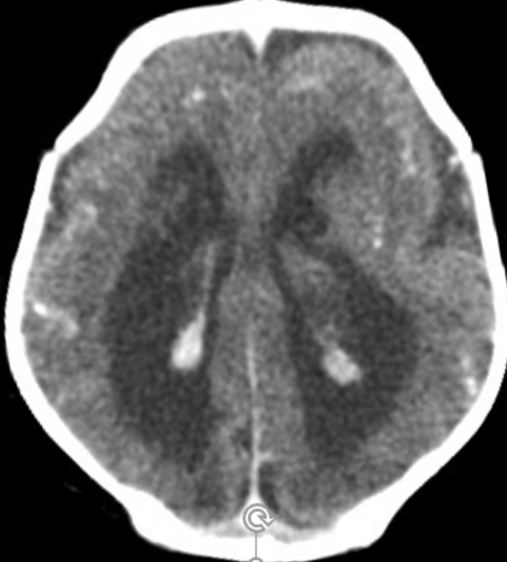 Tip of the day 💡: If CT is all you have, make the most of it. Here, first pick up the band calcification and then, the extensive polymicrogyria. Diagnosis: OCLN mutation.