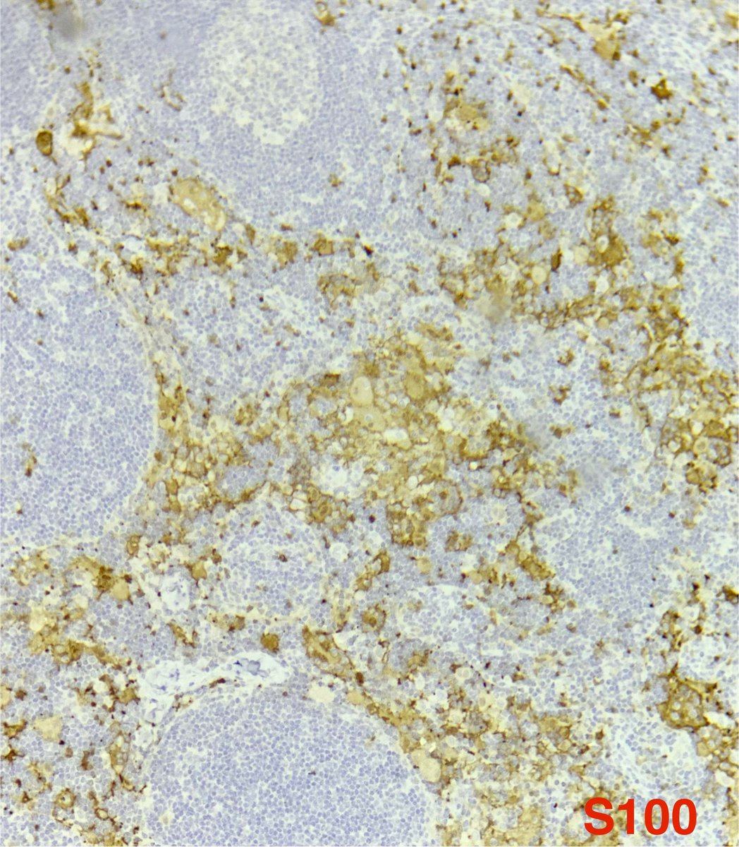 2 year old male with multiple lymphadenopathy 🔬 ⁃Marked sinus expansion ⁃Large histiocytes ⁃Emperipolesis IHC: S100(+) CD207(-) CD1a (-) DX: Rosai-Dorffman disease #Hemepath #PediPath #SurgPath #pathology #PathBoards @janavarro_MD @luishcruzc