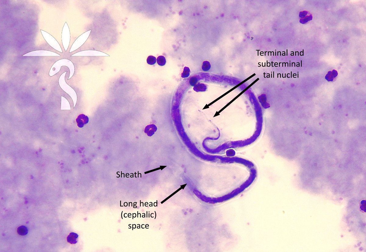 The answer to the #ParasiteCase 743 is now up: Brugia timori – a tricky one to ID! I’m impressed how most got to the genus level. See further discussion here: parasitewonders.blogspot.com/2024/03/answer…. More microfilariae coming your way Idzi Potters and@ITMantwerp! #mayopath #pathology…