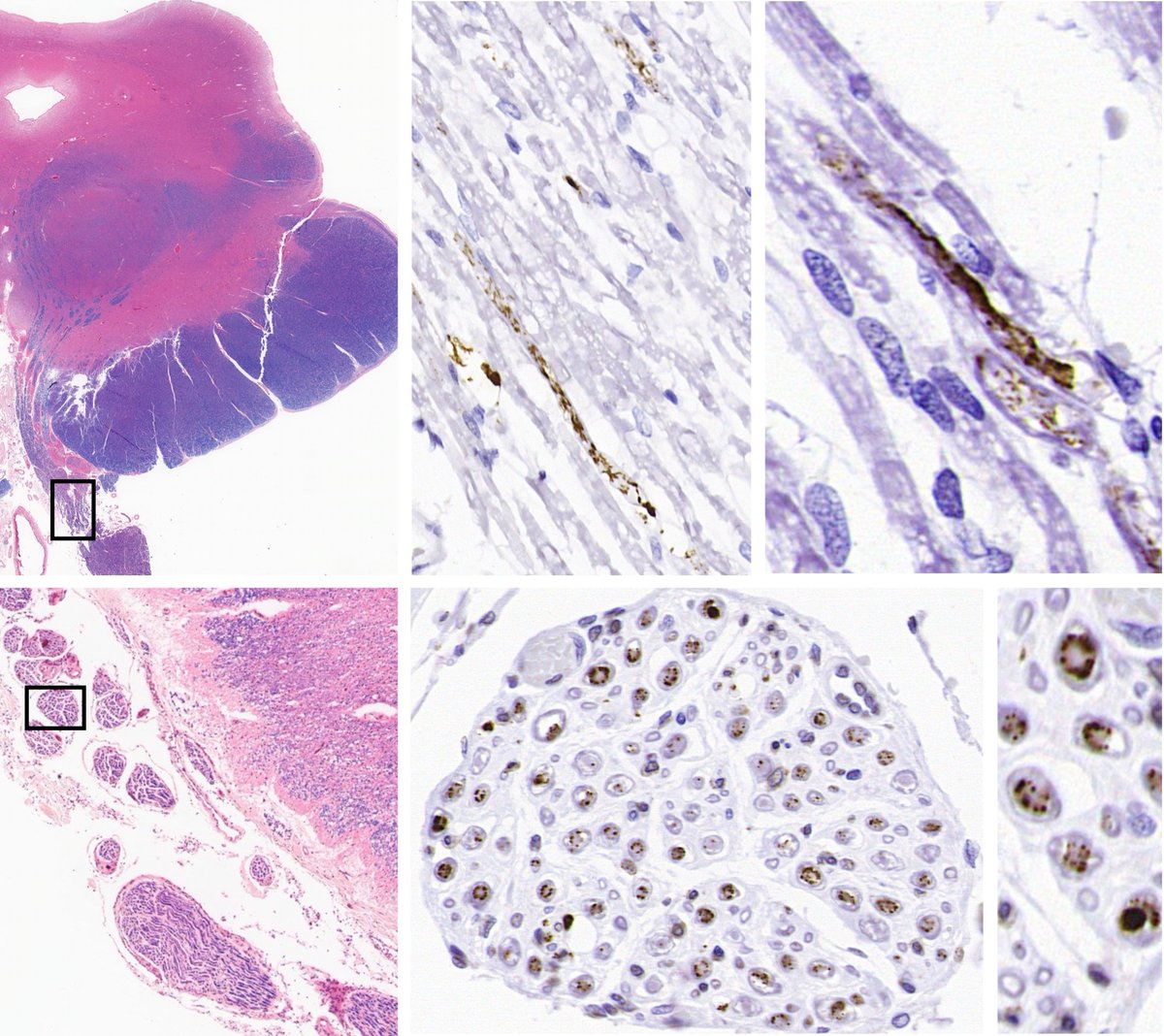 Tanaka et al. investigate whether tau pathology is present in the cranial and spinal nerves of individuals with tauopathies, and find that prominent peripheral nervous system tau distinguishes progressive supranuclear palsy from other tau-based disorders. tinyurl.com/27w7djh8