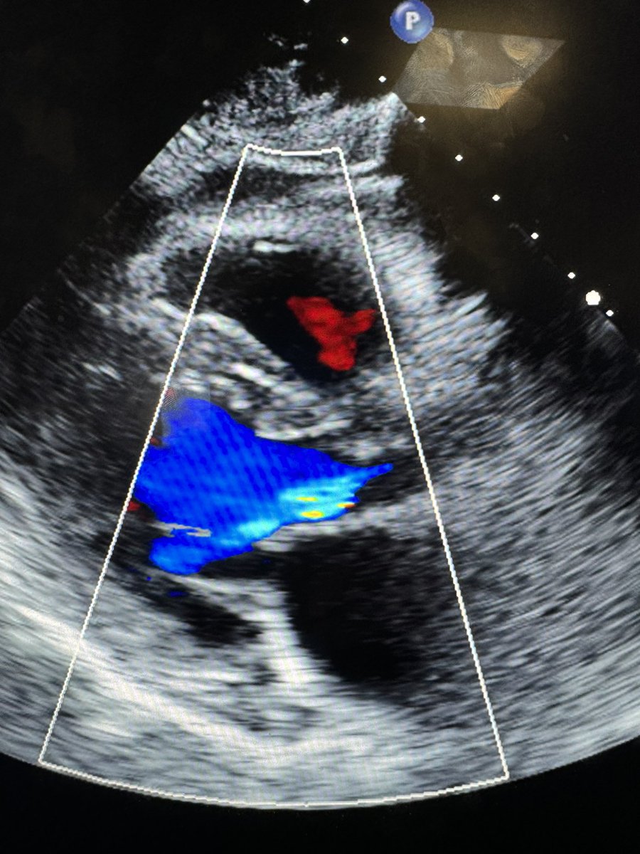bbumc92's tweet photo. Fluttering of anterior leaflet of mitral valve in eccentric AI #CardioTwitter https://t.co/v6YdaS8IN5
