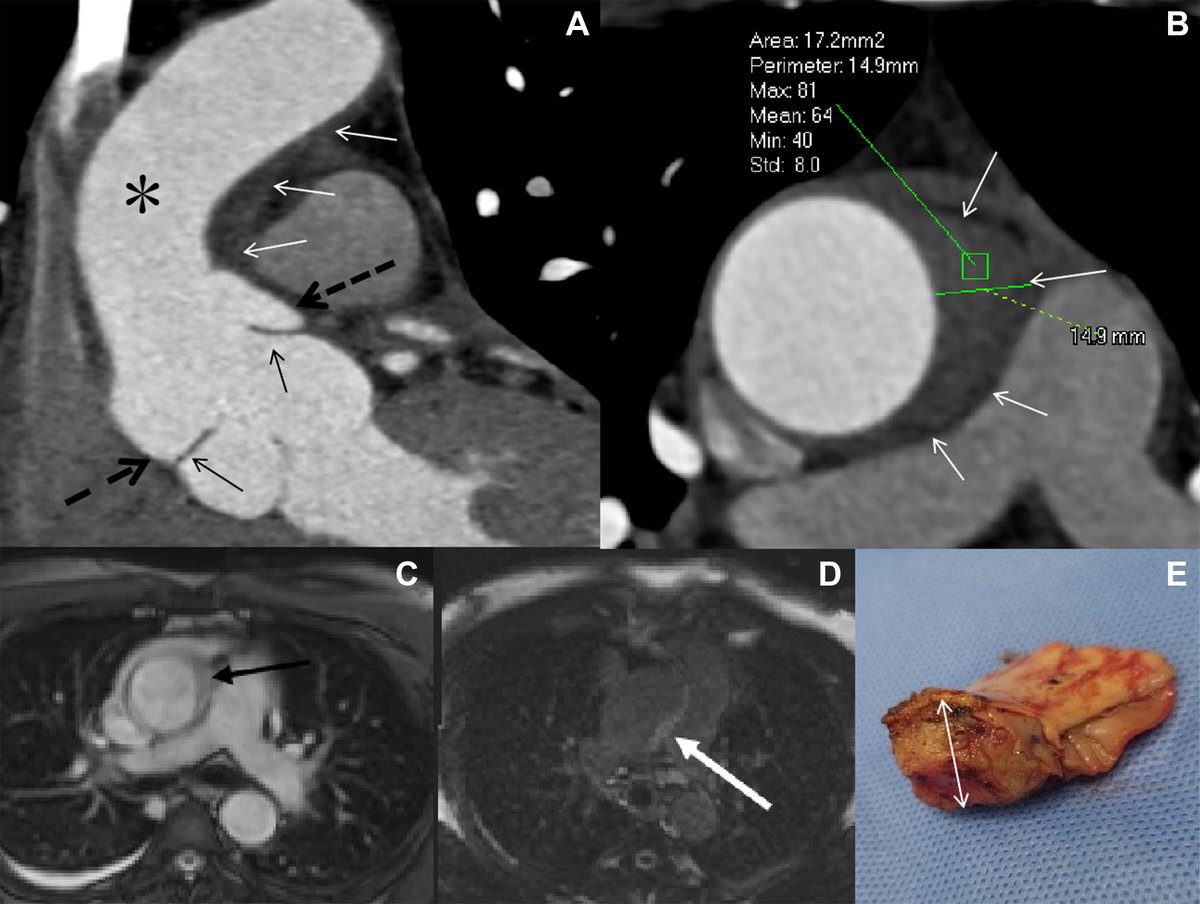 CT angiogram shows ­aortic dissection at the aortic root and thickening of the left aortic wall. MRI revealed a crescentic soft tissue abnormality of the aortic wall with delayed enhancement. At resection, neurofibroma of the ascending aorta was diagnosed. bit.ly/3J4wnd2