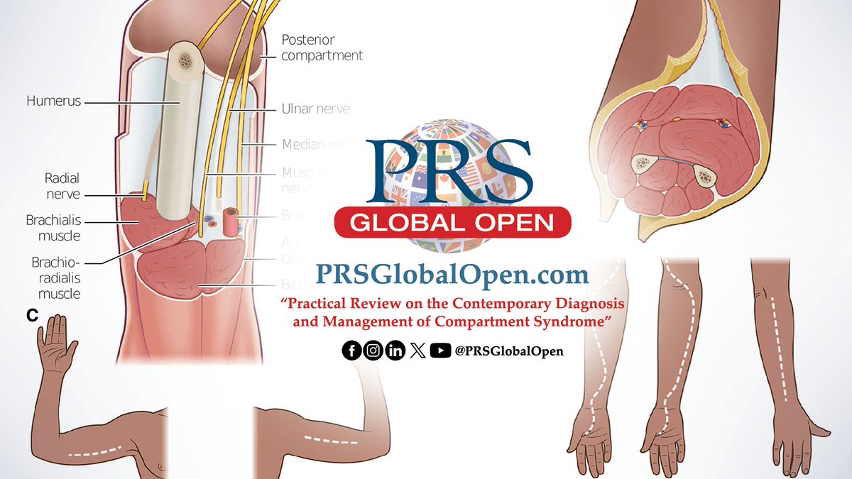 The March 2024 compendium of #PRSGlobalOpen is available NOW! Read articles like 'Practical Review on the Contemporary Diagnosis and Management of Compartment Syndrome' by Davidson, Sutherland, Siska, and @jjanismd: bit.ly/ACSSyndrome