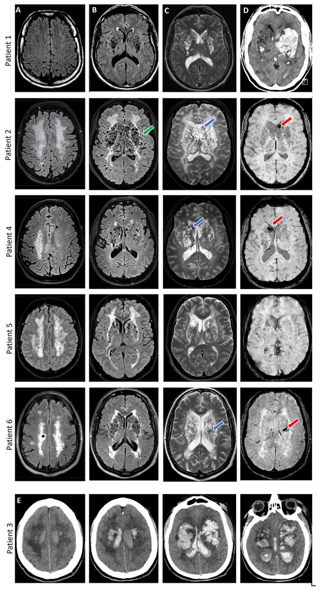 Loss-of-function variants in #NIT1 lead to cerebral small vessel disease and associated #movementdisorder #hemorrhagicstroke bit.ly/43UITp2