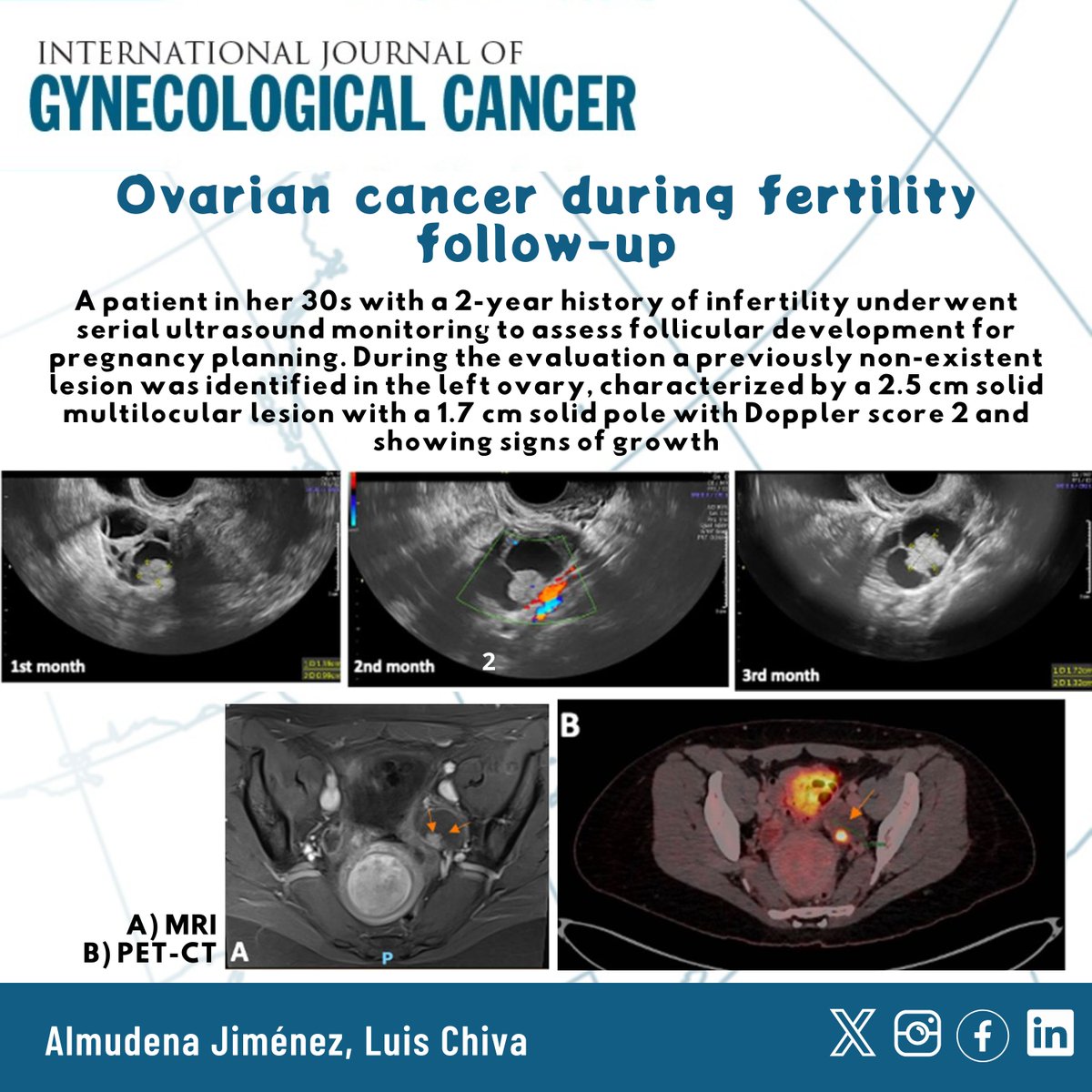 #Images Ovarian cancer during fertility follow-up @lchiv4 📷 bit.ly/3xoNyU1 @pedroramirezMD @HsuMd @JayrajAarthi @AndreFernandes2 @IGCSociety @ESGO_society @ENYGO_official @OncoAlert @IJGCfellows @GynMe4