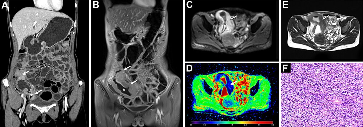 CT enterography in a patient with Crohn disease reveals mural thickening of the ileocecum with hyperenhancement and luminal narrowing; 4 months later, MR enterography revealed progression, and at pathology, diffuse large B-cell lymphoma was diagnosed. bit.ly/3xliioL