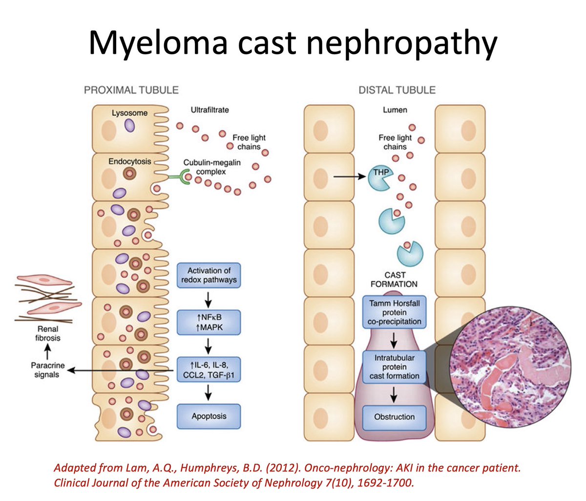 Myeloma kidney: Under physiological conditions, free light chains (FLCs)  are freely filtered through the glomerulus and are endocytosed by PCT cells  through the megalin-cubulin receptor complex, and catabolised. In patients  with MM,