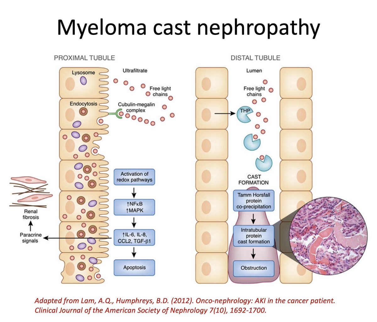 Myeloma kidney:  Under physiological conditions, free light chains (FLCs) are freely filtered through the glomerulus and are endocytosed by PCT cells through the megalin-cubulin receptor complex, and catabolised. In patients with MM, the overproduction of FLCs overcomes the