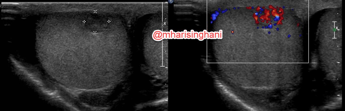 mharisinghani's tweet image. Benign lesions do occur in testis; testicular hemangioma