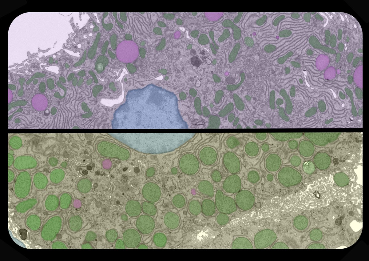 PoratShliomLab's tweet photo. Did you know that hepatocytes, located 300 microns apart, have different mitochondria? Learn how we use advanced microscopy to study mitochondrial physiology in vivo. Sunday 8:45 am Conv. Ctr., 102 #APS2024 #liverzonation #mitochondria https://t.co/5LpdF1PSWX