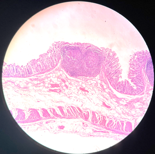 lorenaevilla's tweet photo. Difusse nodular lymphoid hyperplasia of de colon right
Numerous small polypoid nodules.  Well preserved mucosal architecture and many hyperplastic lymphoid follicles with  reactive germinal centers. #pathology #pathTwitter #GIpath  #pathweet #PathTweetAward https://t.co/DFto0mn0nX
