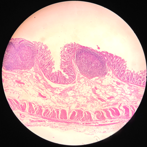 lorenaevilla's tweet photo. Difusse nodular lymphoid hyperplasia of de colon right
Numerous small polypoid nodules.  Well preserved mucosal architecture and many hyperplastic lymphoid follicles with  reactive germinal centers. #pathology #pathTwitter #GIpath  #pathweet #PathTweetAward https://t.co/DFto0mn0nX