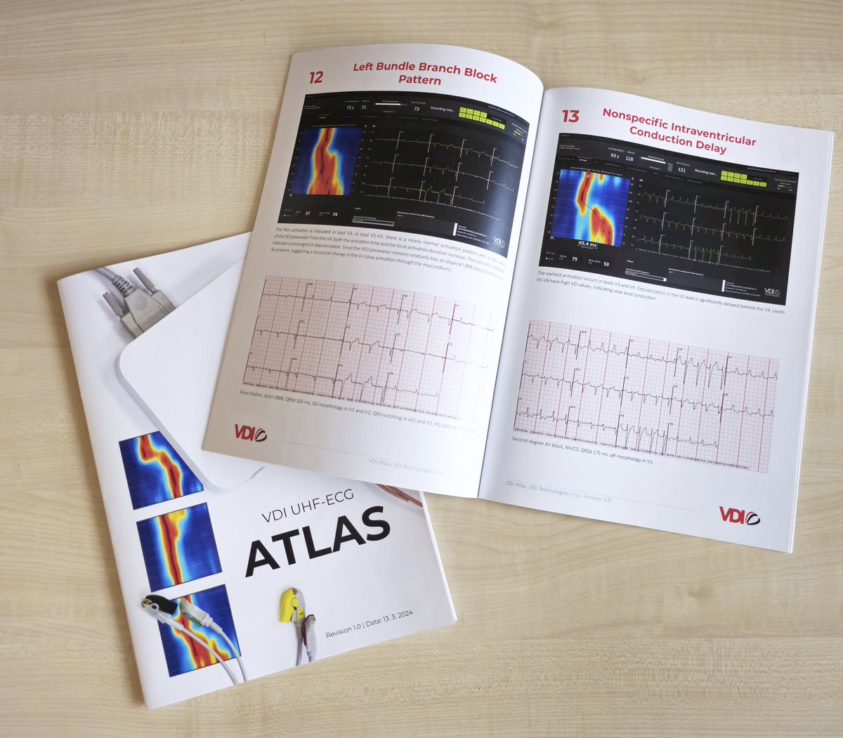 #EHRA2024 Come and check the very first ventricular dyssynchrony atlas based on the UHF-ECG       (VDI booth).  We are rescaling learning curve from hundreds of cases to only several.  #CSP #IVCD #CRT