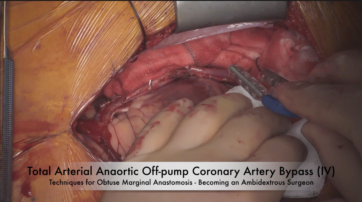 “Deep Dive Into Total Arterial Anaortic Off-Pump CABG: Radial Artery to Obtuse Marginal Artery Anastomosis” | This video from Prof. Tristan Yan’s OPCABG series demonstrates an off-pump RA to OM anastomosis performed with a side-to-side technique. ow.ly/fRpr50R9suk