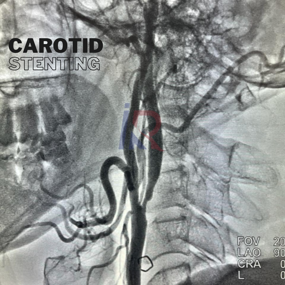 Carotid Stenting Procedure by Dr. Alok K Udiya. #CarotidStenting #MinimallyInvasiveProcedure Carotid stenting is a minimally invasive procedure used to treat carotid artery disease, which involves the narrowing of the carotid arteries due to plaque buildup +91 99993 78980