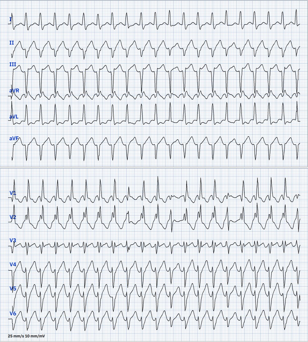 Most of us are not EP specialists. We just want to know where this VT is coming from (RV/LV) and whether it is more benign (outflow tract tachycardia) or malignant (related to CHD/IHD). What can you say about this tachycardia?