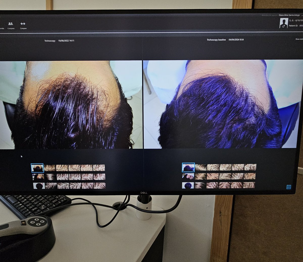 #trasplantecapilar en región frontal. Resultado a 9 meses. Técnica FUE 
#hairrestoration #hairsurgery #FUEtechnique #trichology #dermatology #hairloss #hairtreatment . #trichologytimes 🔛