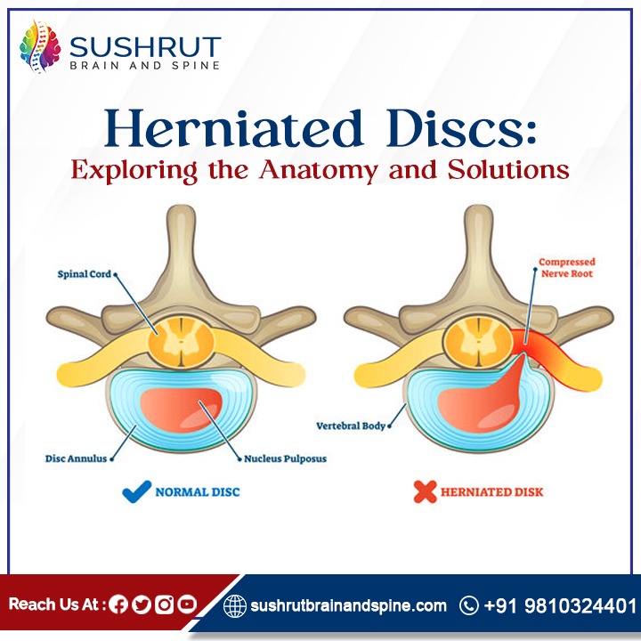 Dive into the anatomy of spinal discs and understand the impact of herniated discs on your spine health. Discover how neurosurgery techniques offer targeted relief and restoration.

#HerniatedDisc #SpineAnatomy #NeuroSurgery