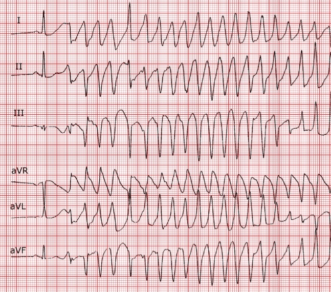 ECG spot Diagnosis. Case 7. You are the cardio Reg on call. 77yrs M brought by Ambulance, presents with Palpitations and dizziness. BP 68/40 mmHg. 1. Diagnosis? 2. Immidiate Treatment?