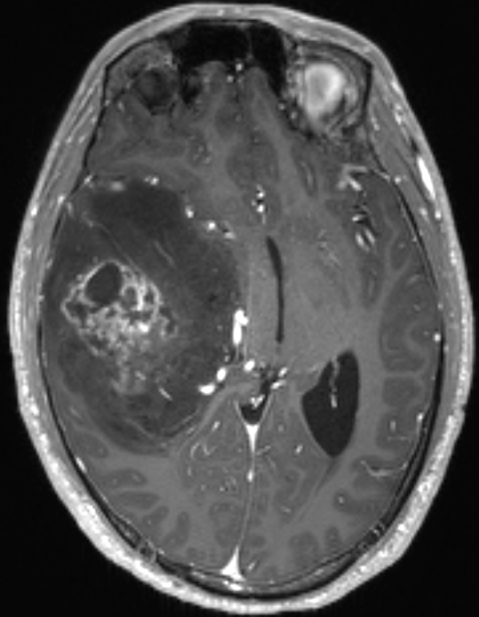 33 year old male presents with seizure. MRI reveals a brain tumor as shown. Can you make the WHO CNS 2021 diagnosis on this single image?