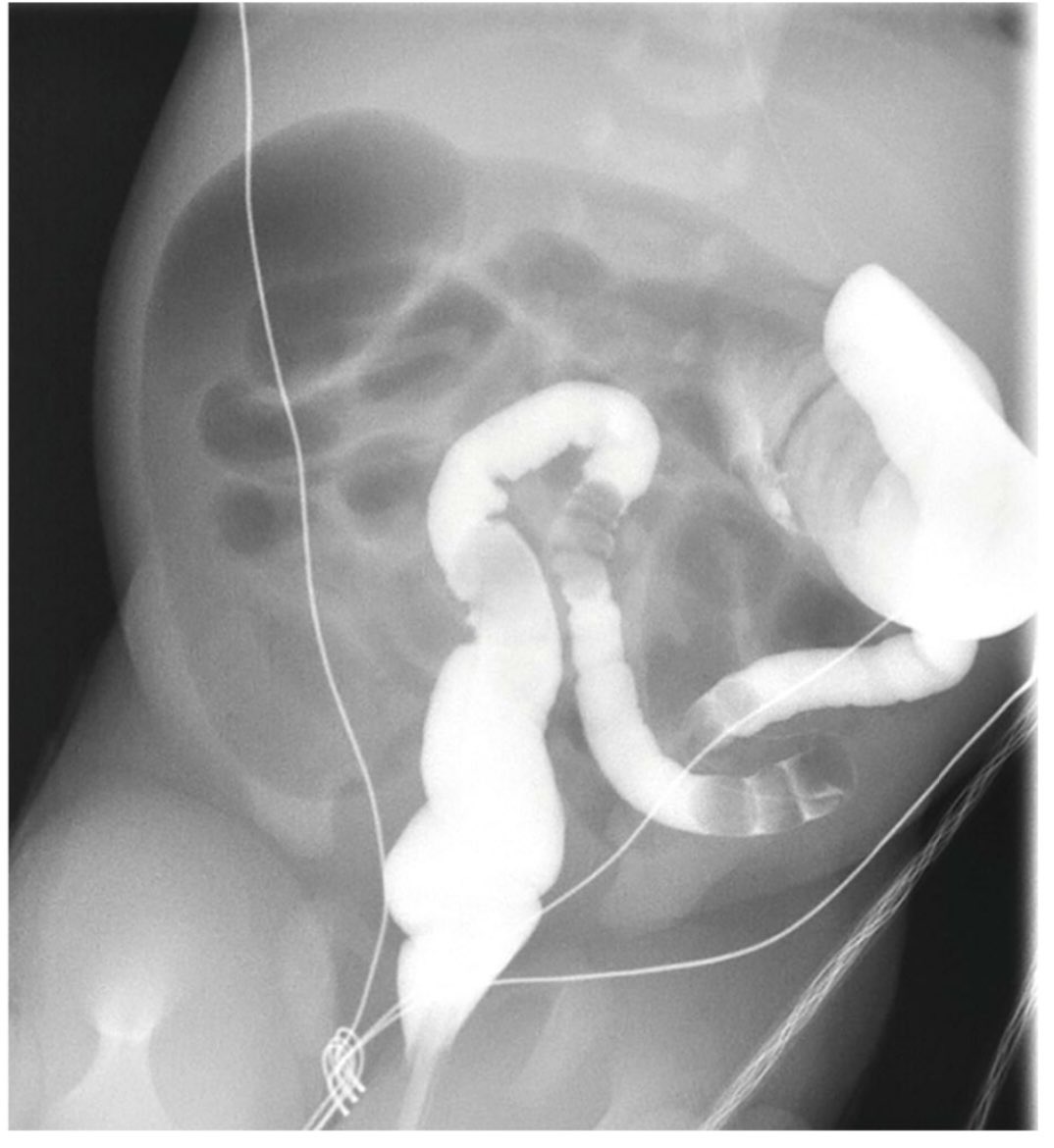 Diagnosis? Neonate failure to pass meconium #Radiology_resident #Gastrointestinalradiology #MedTwitter #foamrad #Foammed #pediatricresident