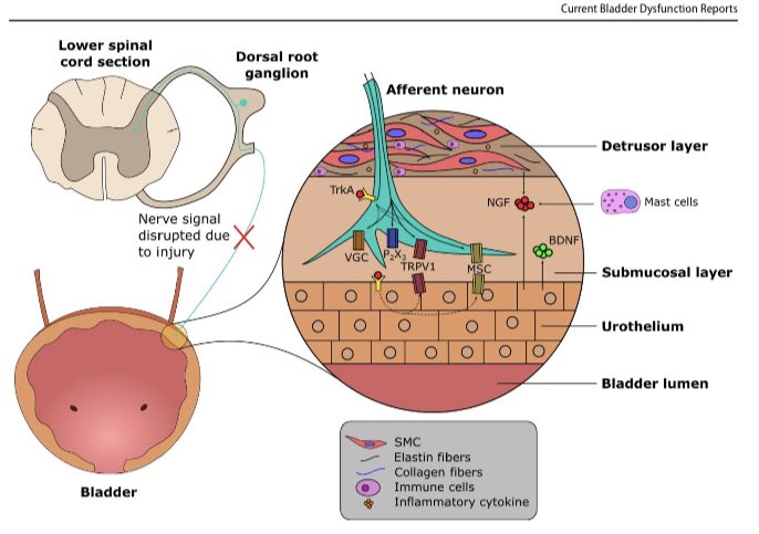 Excited to share our paper on the role of recent regenerative approaches (stem cells, SDF-1, neural progenitor cells, etc) in the treatment of neurogenic bladder @HijazAdonis @Thomas_R_Wong @CaseUrology Where are we in 2023?! Link ⬇️ link.springer.com/article/10.100…